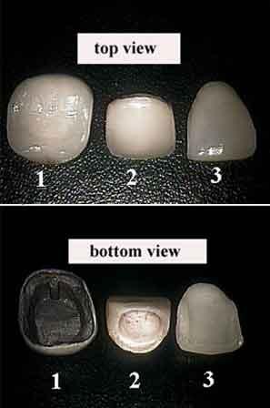 Veneer (dentistry) - Wikipedia