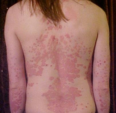 Psoriasis — Wikipédia