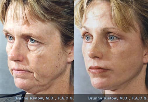 Rhytidectomie — Wikipédia