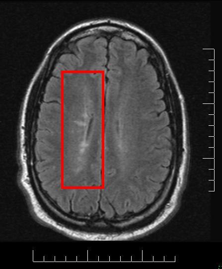 Lesional demyelinations of the central nervous system - Wikipedia