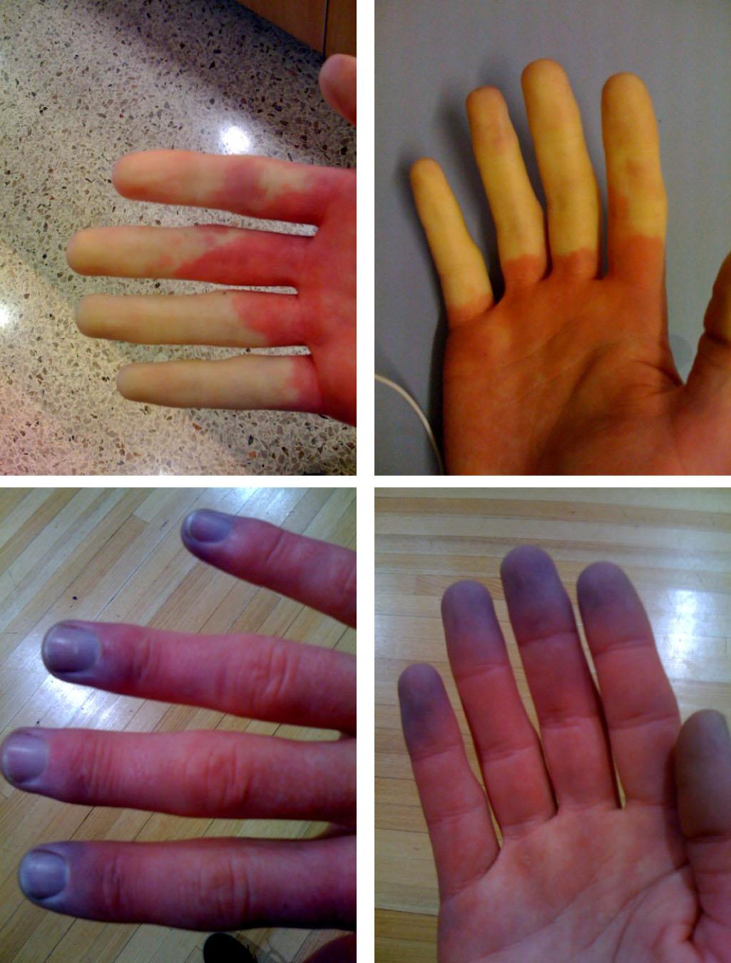 Syndrome de Raynaud — Wikipédia