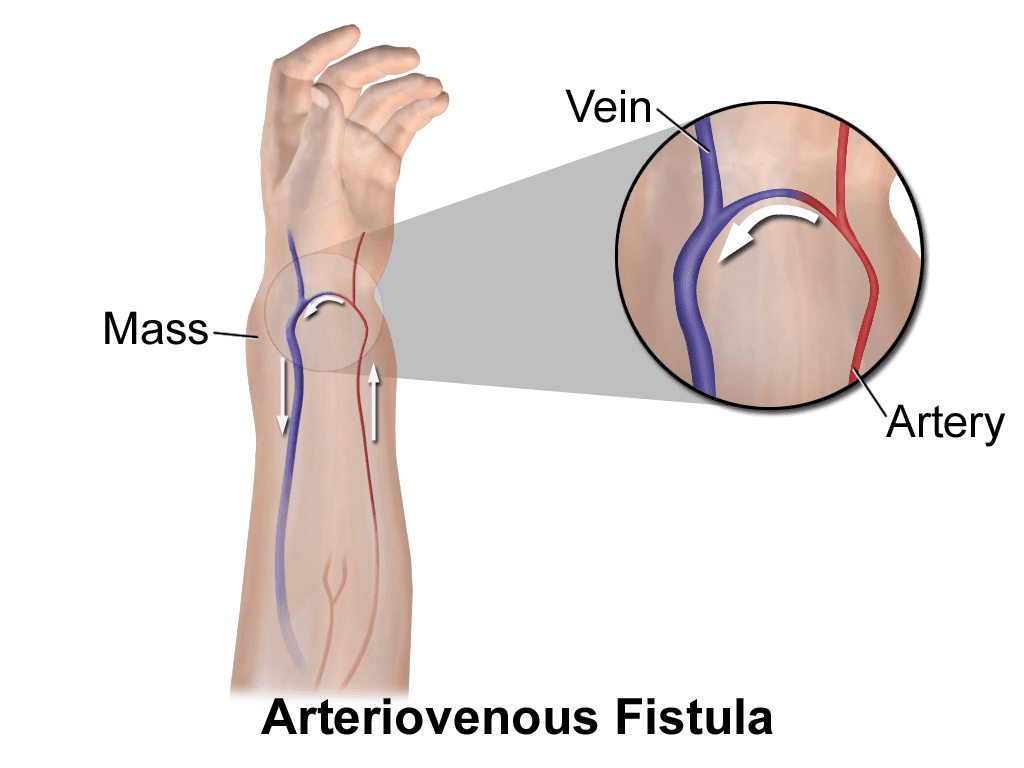 Arteriovenous fistula - Wikipedia