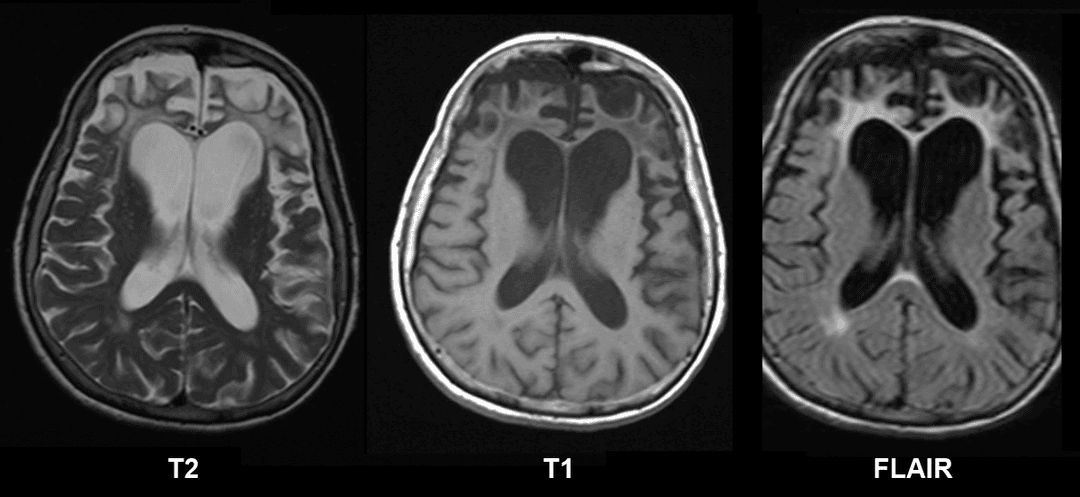 Frontotemporal dementia - Wikipedia