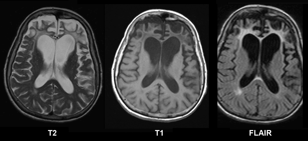 Frontotemporal dementia - Wikipedia