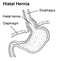 Hiatal hernia - Wikipedia