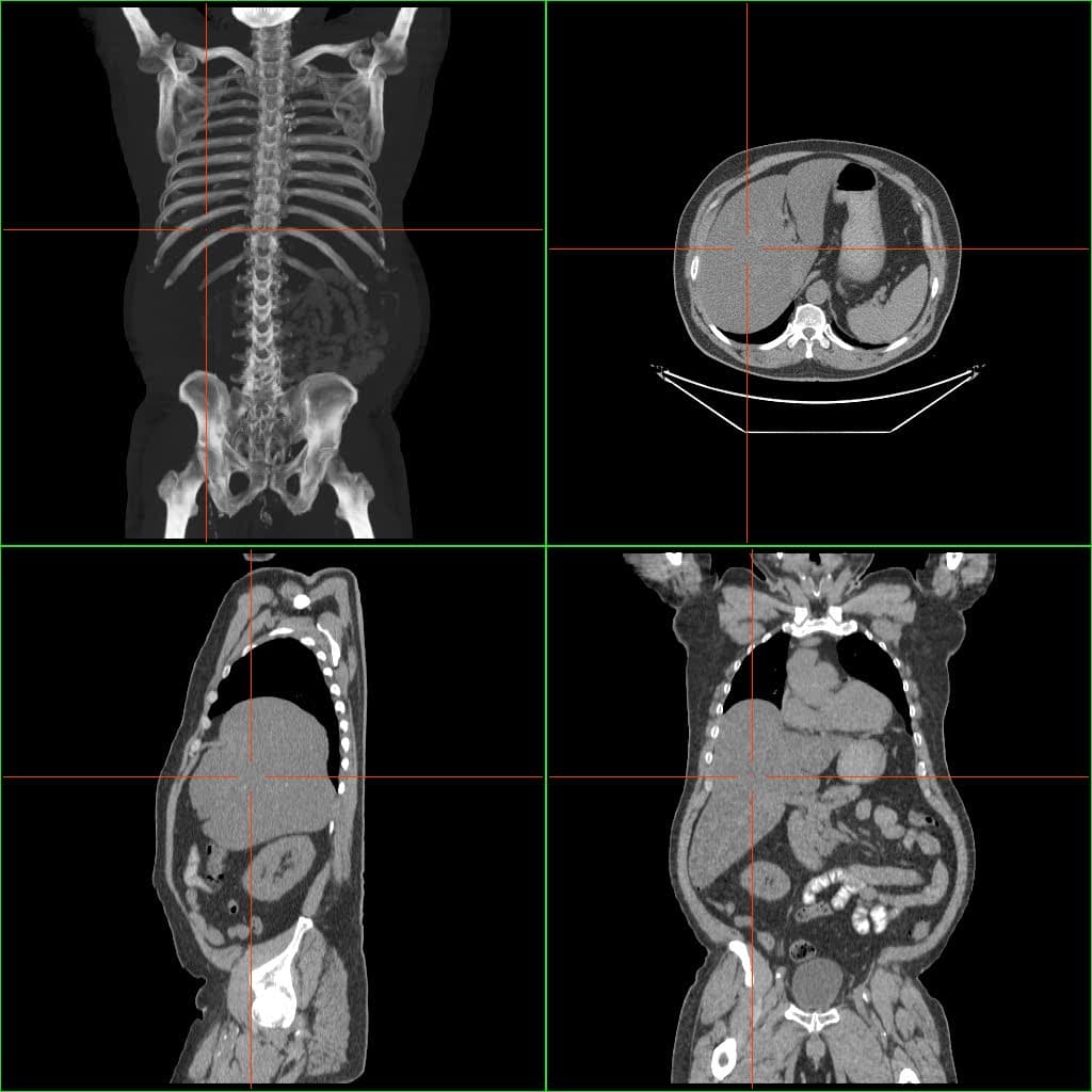 Hepatomegaly - Wikipedia