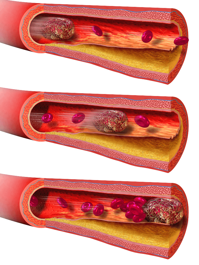 Thrombose — Wikipédia