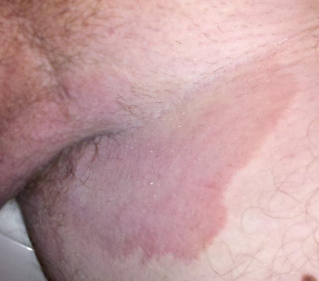 Tinea cruris - Wikipedia