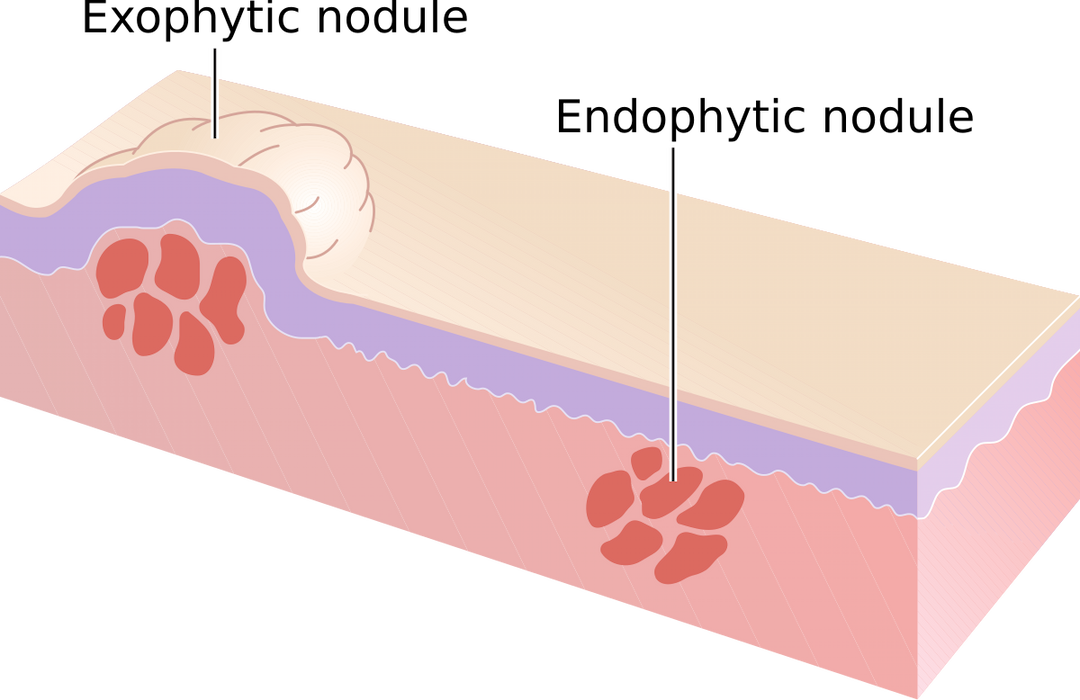 Nodule (médecine) — Wikipédia