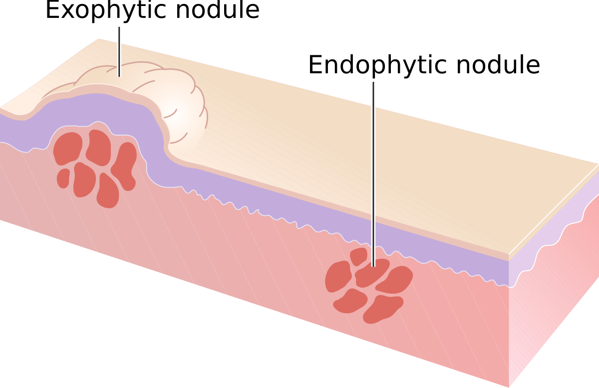 Nodule (médecine) — Wikipédia