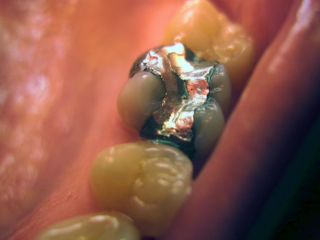 Amalgam (dentistry) - Wikipedia