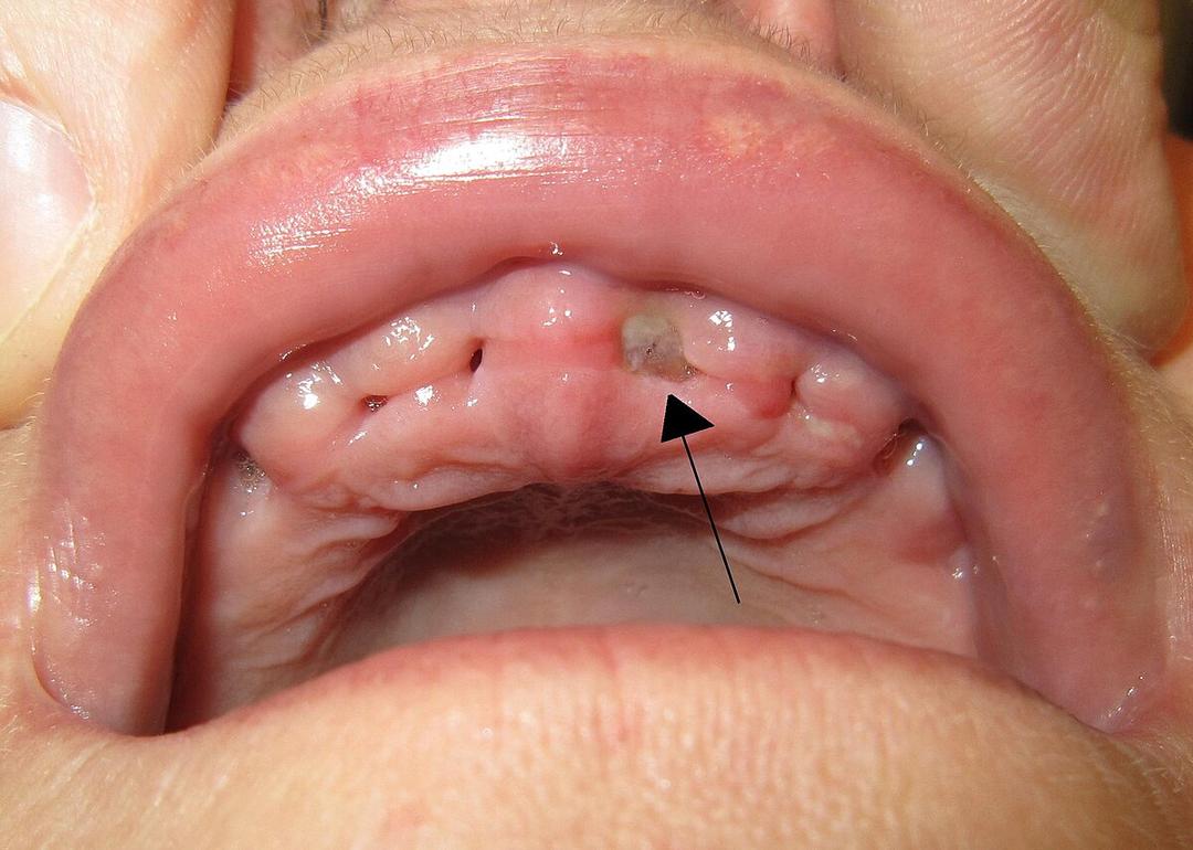 Alveolar osteitis - Wikipedia