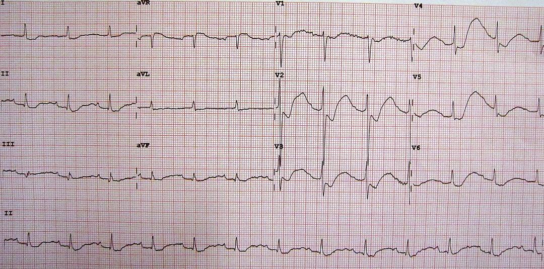 Hypokalemia - Wikipedia