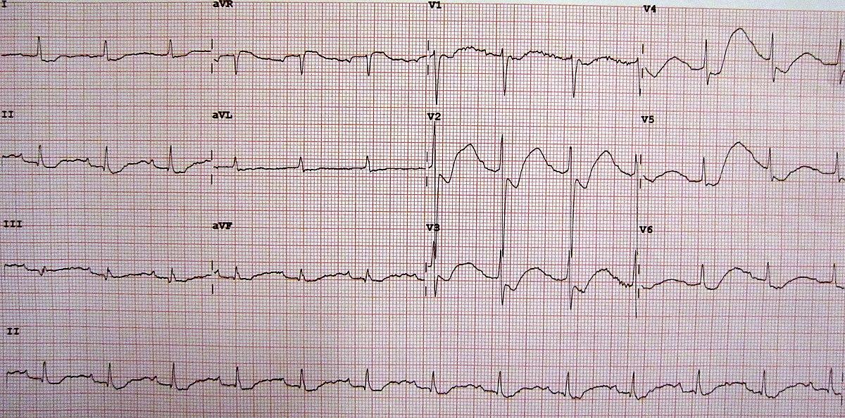 Hypokalemia - Wikipedia