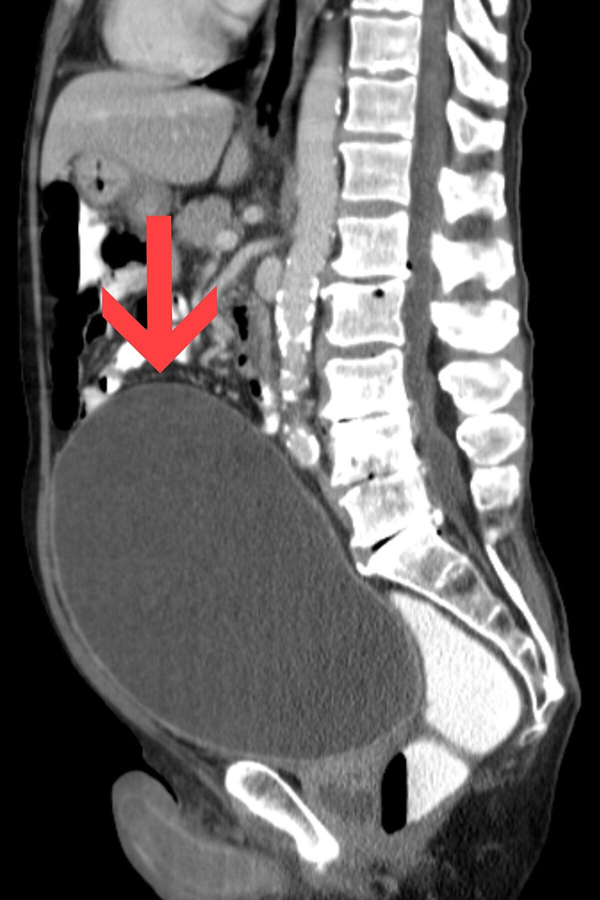 Rétention aiguë d'urine — Wikipédia