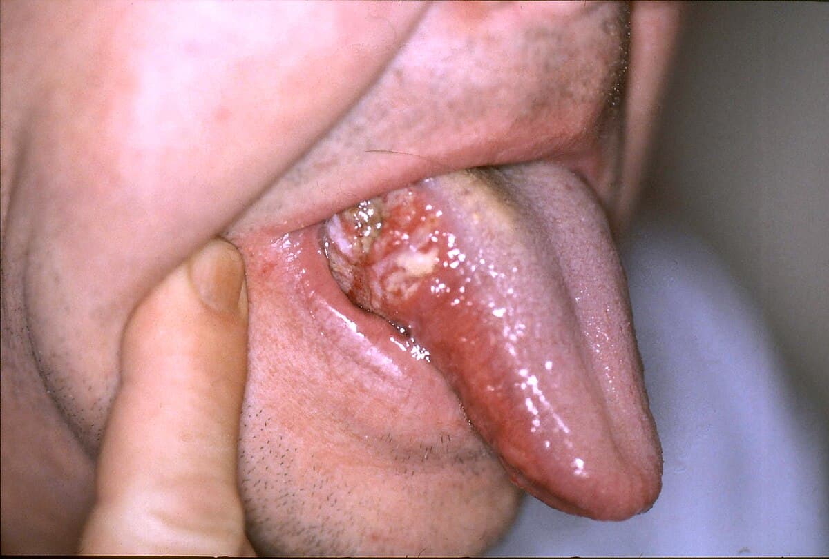 Oral cancer - Wikipedia