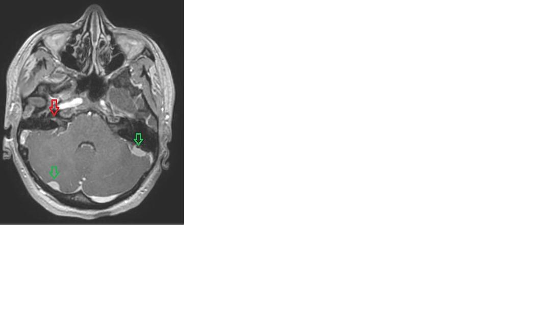 Neurofibromatose de type II — Wikipédia