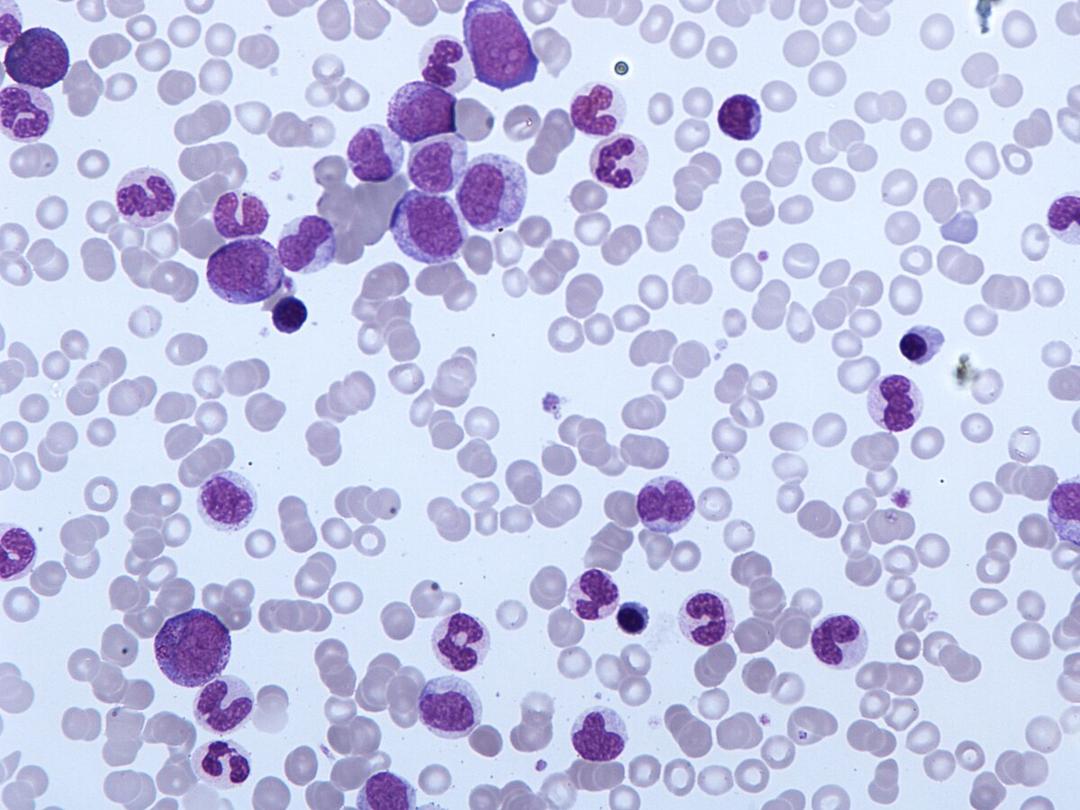 Chronic myelomonocytic leukemia - Wikipedia