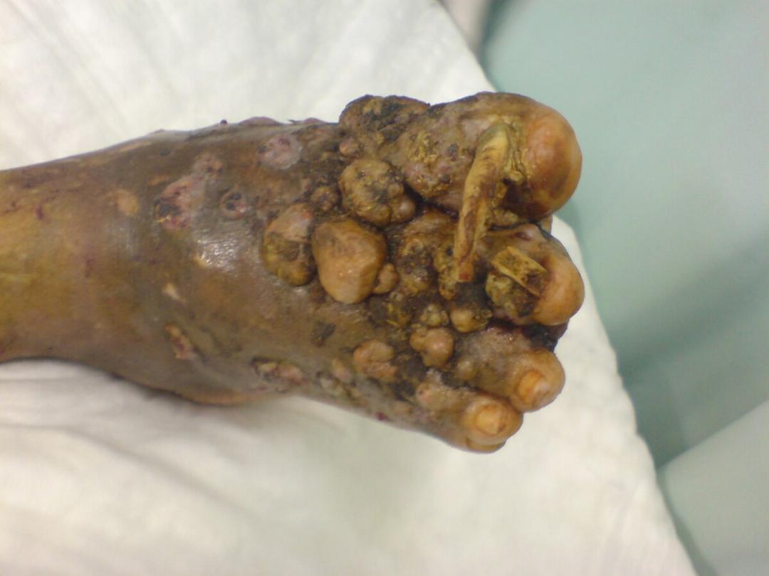 Eumycetoma - Wikipedia