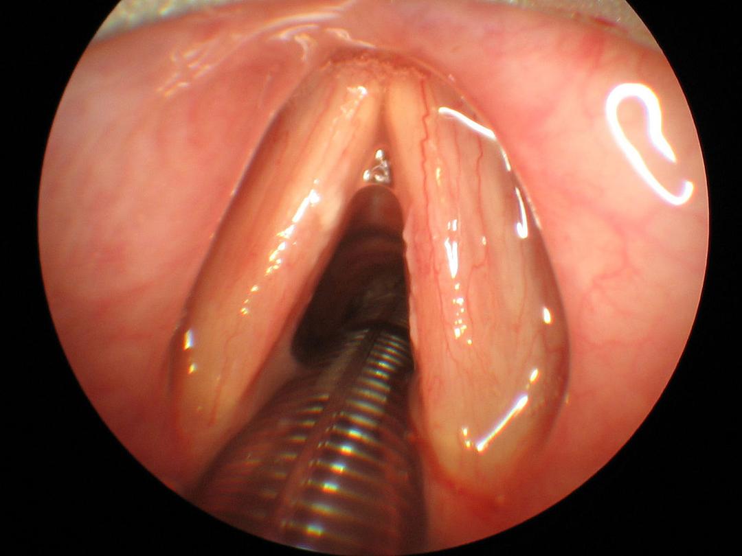 Intubation trachéale — Wikipédia