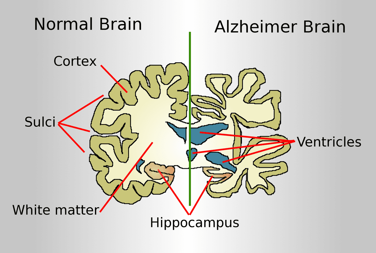 Alzheimer's disease - Wikipedia