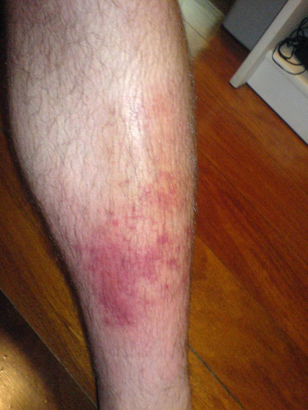 Cellulitis - Wikipedia