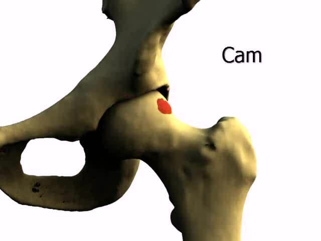 Femoroacetabular impingement - Wikipedia