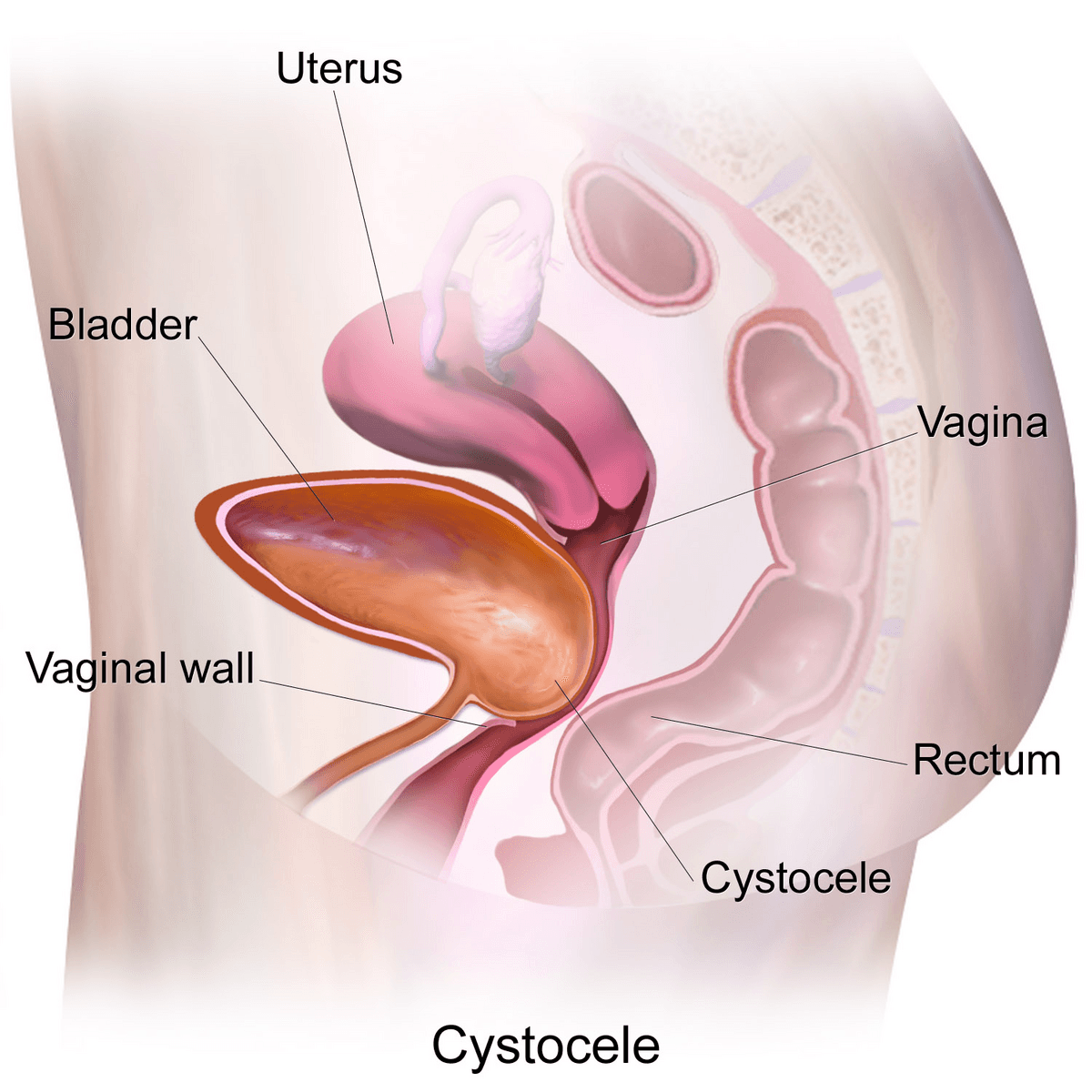 Cystocèle — Wikipédia