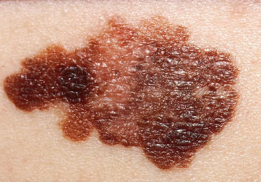 Melanoma - Wikipedia