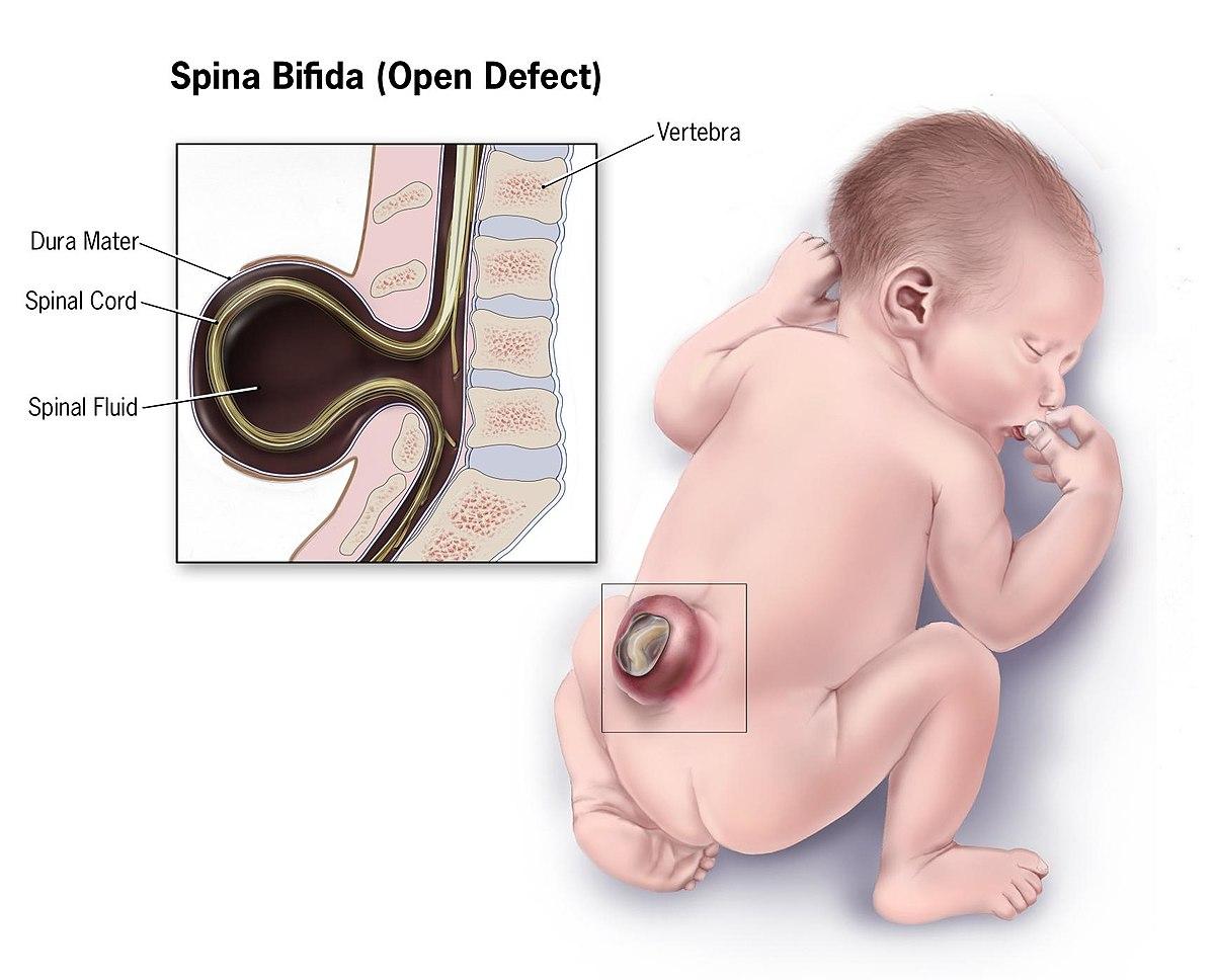 Spina bifida - Wikipedia