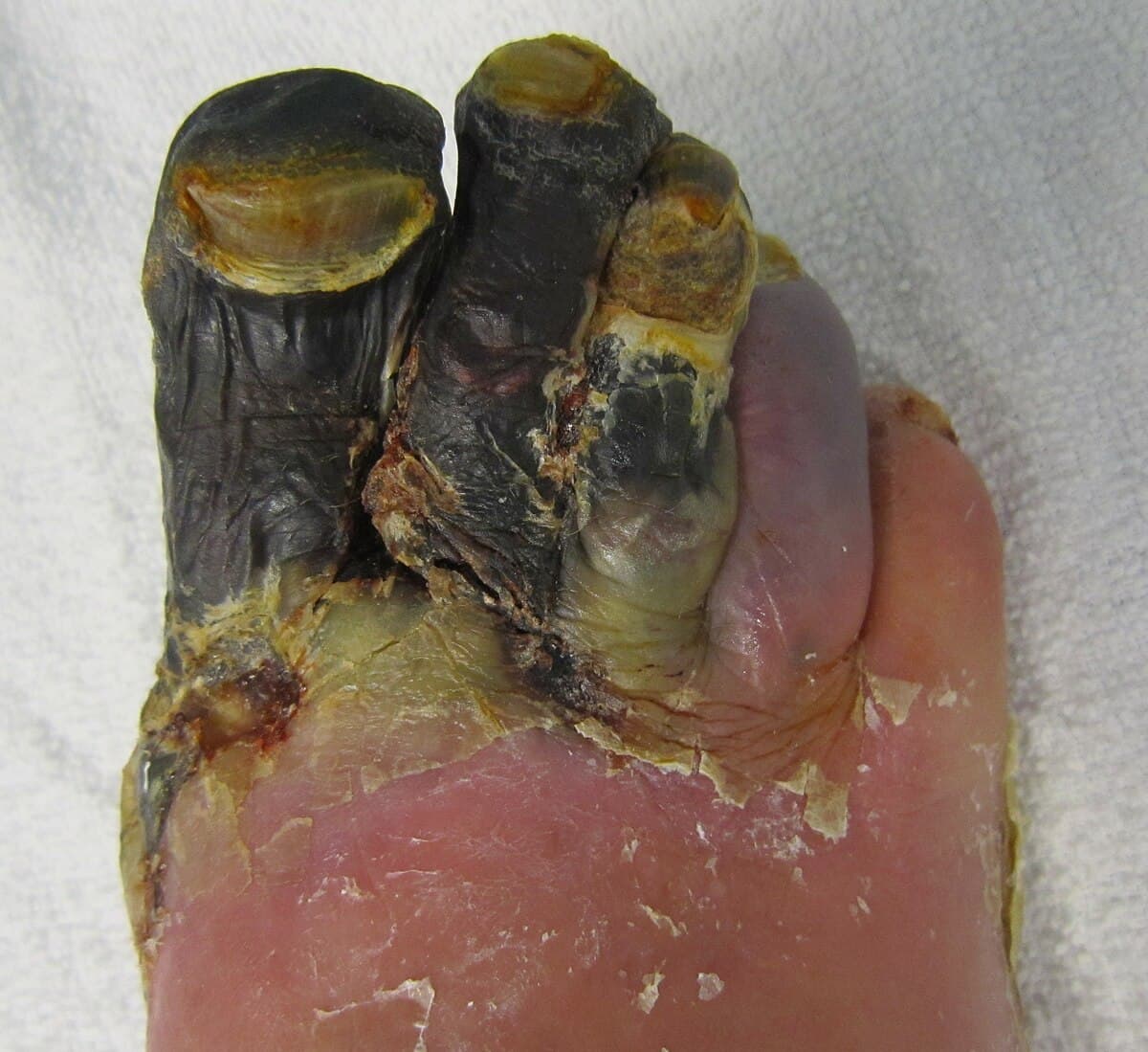 Gangrene - Wikipedia