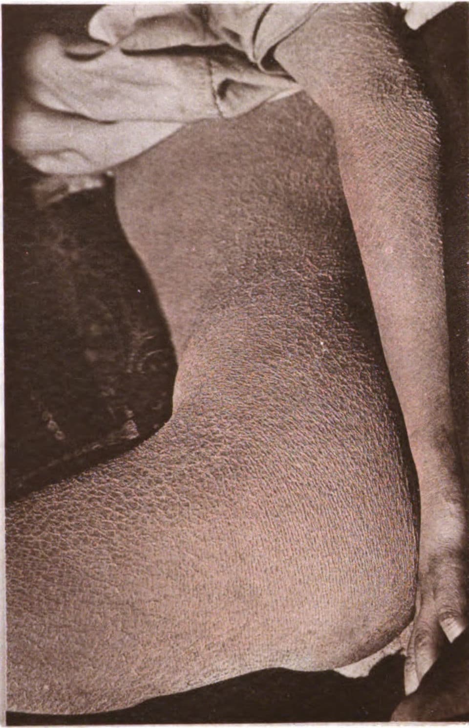 Ichtyose — Wikipédia