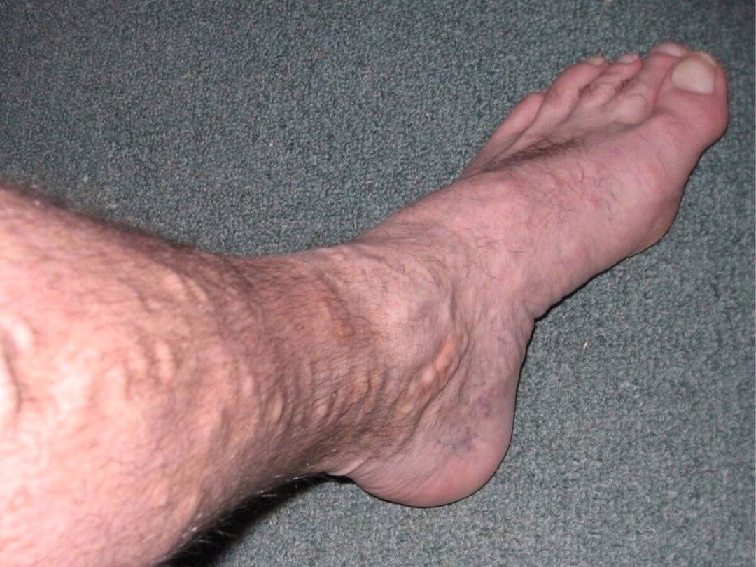 Varicose veins - Wikipedia