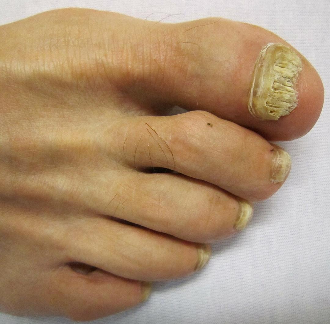 Onychomycosis - Wikipedia