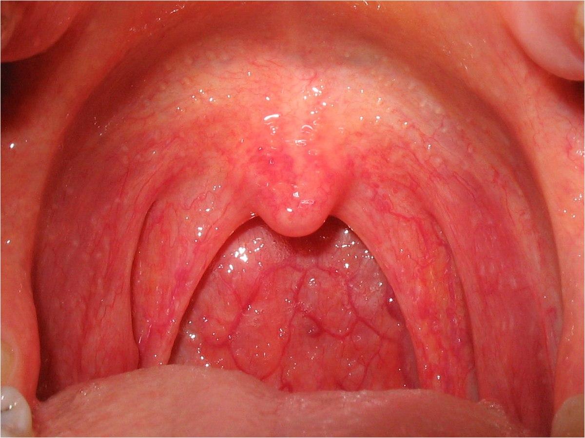 Sore throat - Wikipedia