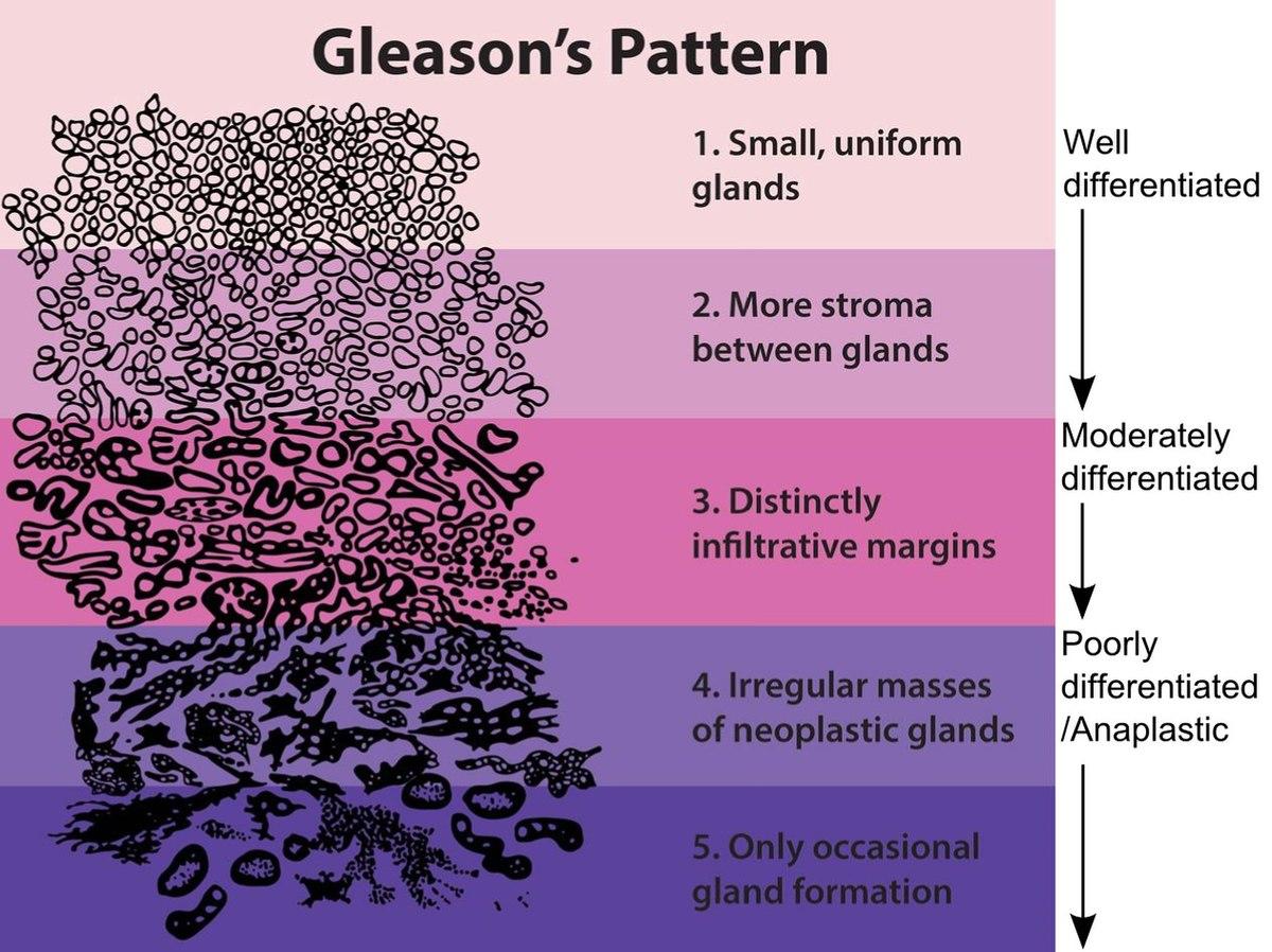 Grade histologique — Wikipédia