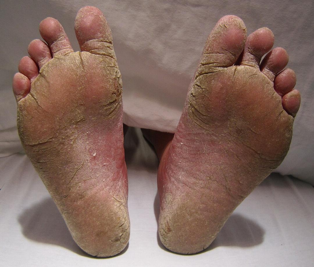 Athlete's foot - Wikipedia