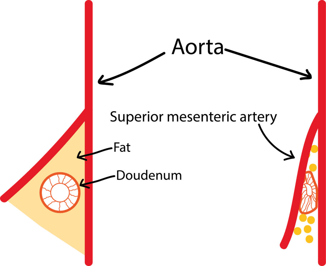 Superior mesenteric artery syndrome - Wikipedia