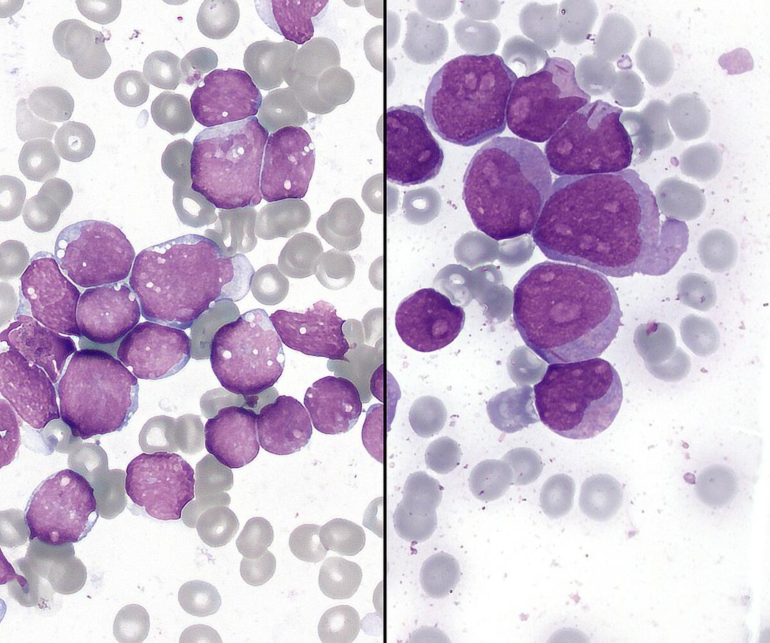 Leukemia - Wikipedia