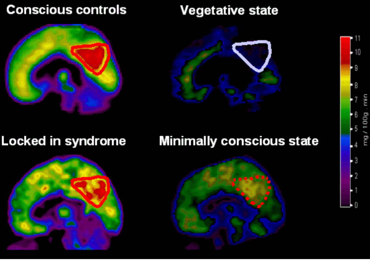 Minimally conscious state - Wikipedia